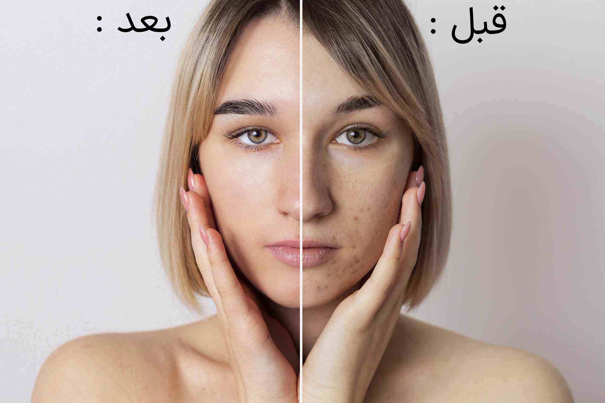 فواید میکرودرم ابرژن