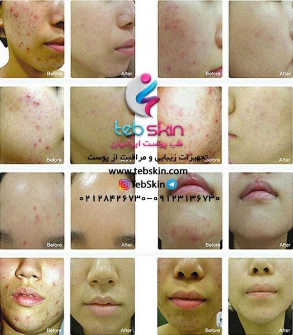 تونل نوردرمانی 7 رنگ LED کلسیم تراپی Devoir Plm002 - تصویر 6