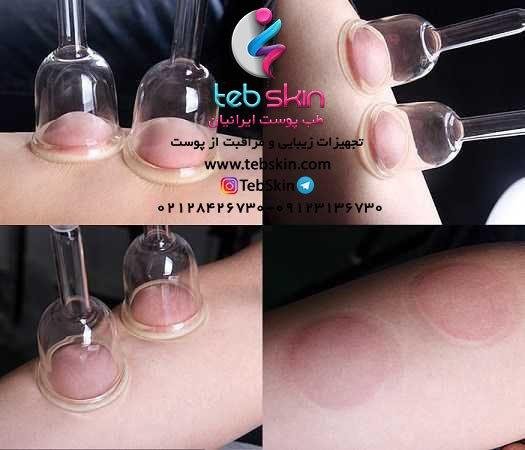 دستگاه وکیوم سینه و باسن - تصویر 4